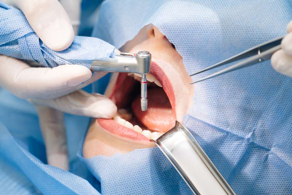 Close-up,Shot,Of,Attentive,Doctors,Performing,Surgical,Operation,Installing,Dental